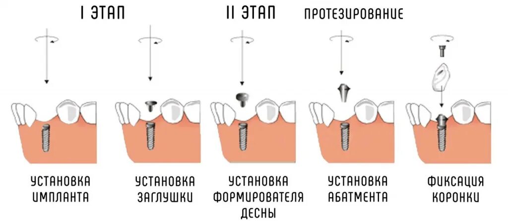 Процесс установки импланта пошагово с фото Сравнение одноэтапной и двухэтапной методики имплантации зубов. Доступная стомат