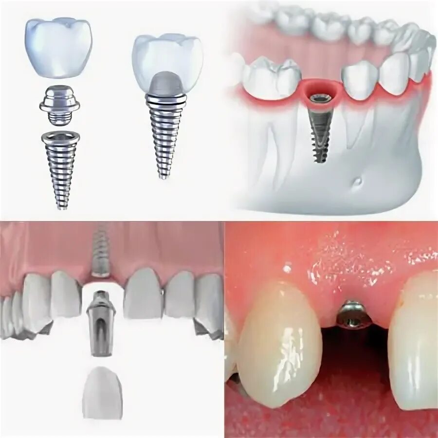 Процесс установки импланта зуба поэтапно фото Одномоментная имплантация зубов в СПб: цены в стоматологии Axioma Dental