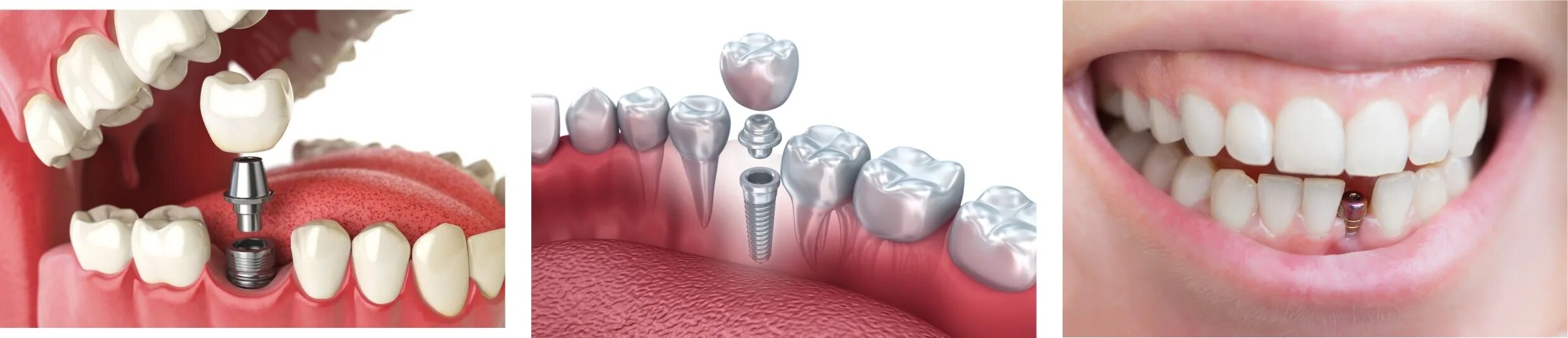 Процесс установки импланта зуба поэтапно фото Имплантация верхних и нижних зубов: особенности и сроки
