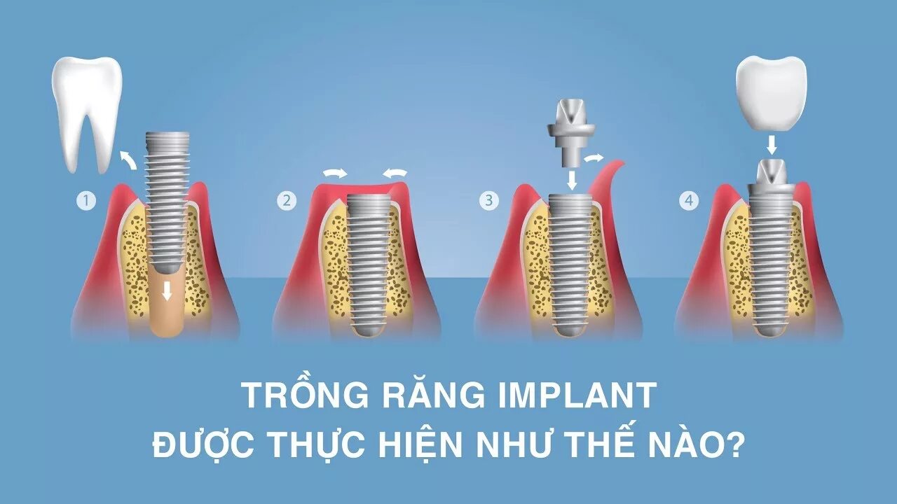 Процесс установки импланта зуба поэтапно фото пошагово Trồng răng Implant Được Thực Hiện Như Thế Nào? - YouTube