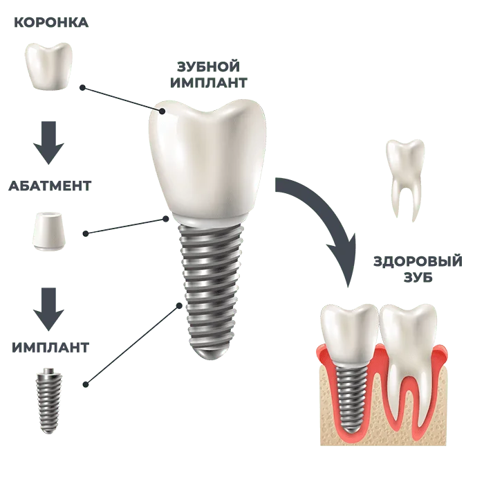 Процесс установки импланта зуба поэтапно фото пошагово Имплантация зубов под ключ в Тольятти от 21 990 рублей