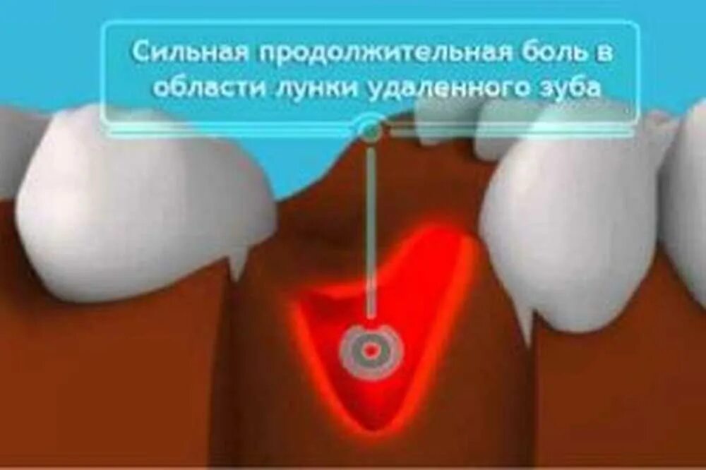 Процесс заживления лунки после удаления зуба фото Как восстановиться после удаления зуба: найдено 90 изображений