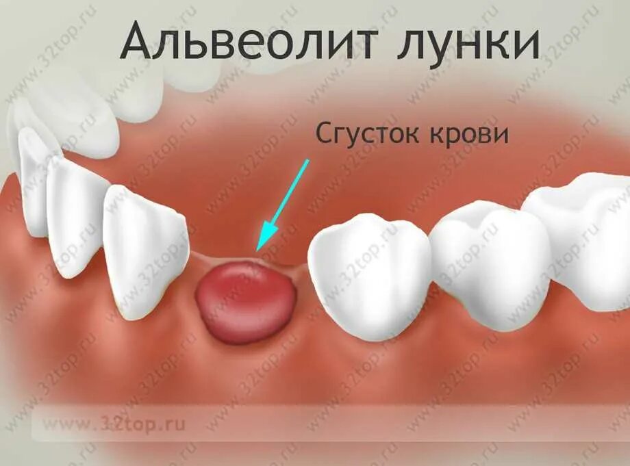 Процесс заживления лунки после удаления зуба фото Альвеолит лунки: причины, симптомы, лечение