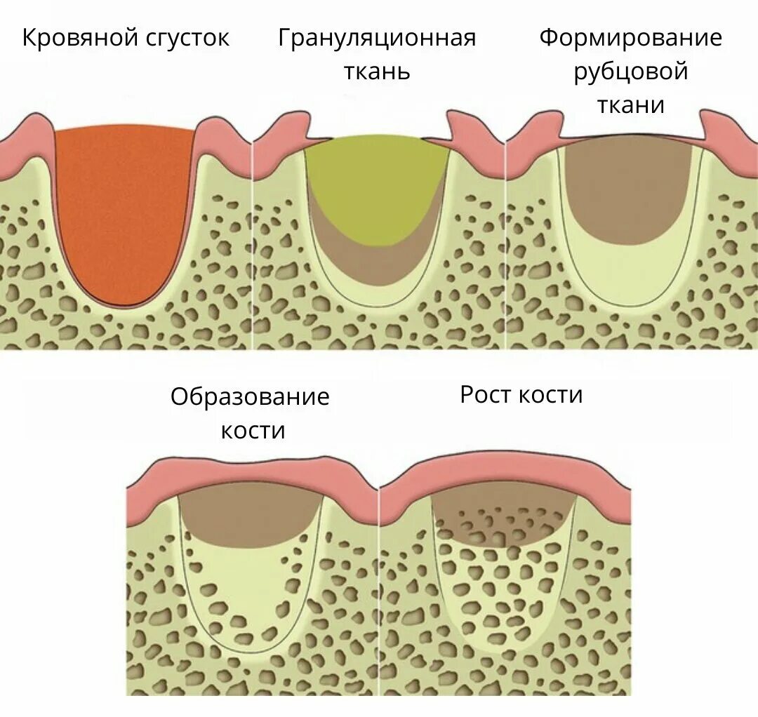 Процесс заживления лунки после удаления зуба фото Отек щеки после удаления зуба мудрости: причины, симптомы и способы лечения. Сто