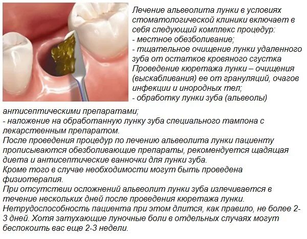 Процесс заживления лунки после удаления зуба фото Картинки МОЖНО ЛИ ПИТЬ ПРИ УДАЛЕНИИ ЗУБА