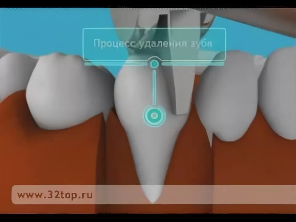 Процесс заживления лунки после удаления зуба фото Альвеолит лунки. Альвеолит лечение - YouTube