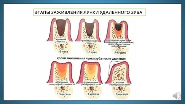 Процесс заживления лунки после удаления зуба фото Про нашу регенерацию / Хабр