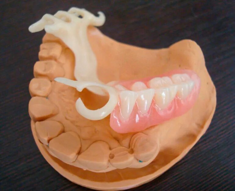 Протез квадротти на верхнюю челюсть фото Бюгельные протезы: на челюсть, на замках, виды и преимущества, материалы, кламме
