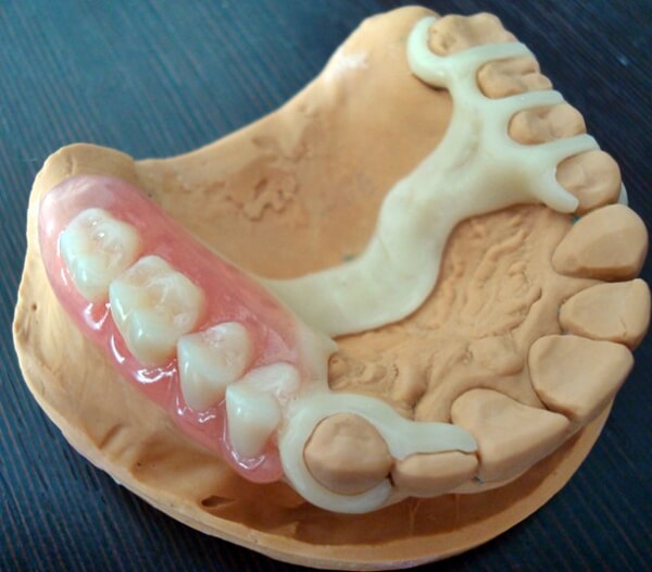 Протез квадротти на верхнюю челюсть фото Зубной ацеталовый протез - Стоматология Mr. Dent
