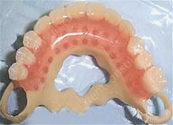 Протез квадротти на верхнюю челюсть фото цена Протез квадротти на нижнюю челюсть цена в москве отзывы - Фото