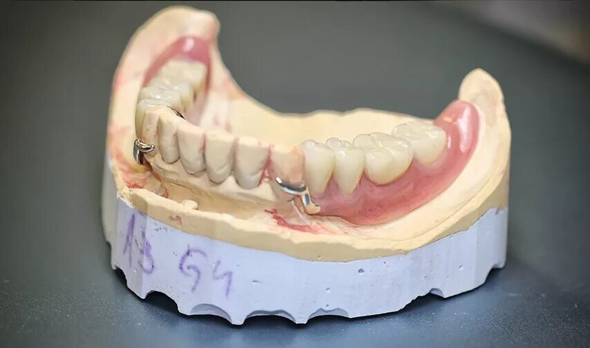 Протез нижней челюсти фото Бюгельные зубные протезы на нижнюю челюсть - фото разновидностей