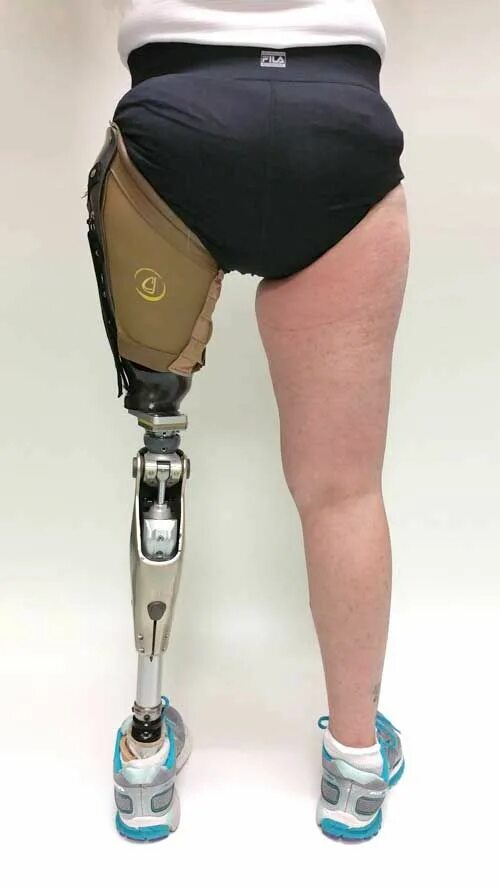 Протез ноги выше колена фото The world's next generation prosthetic socket CJ Socket United States Orthotics 