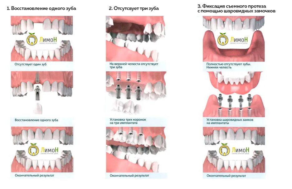 Протезирование передних верхних зубов варианты фото Цена на протезирование зубов на имплантах в Москве - клиника Лимон