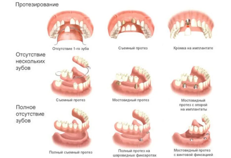 Протезирование передних верхних зубов варианты фото Протезирование зубов - виды и цены в Москве Стоматология Максима Шубных на Можай