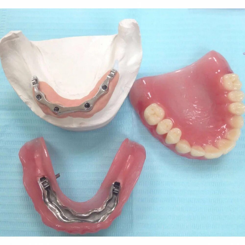 Протезирование верхней челюсти фото Балочный протез на имплантатах - альтернатива съемному протезированию Стоматолог
