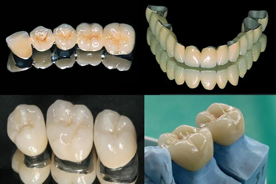 Протезирование зубов металлокерамикой фото Металлокерамическая коронка в Минске Цена протезирования металлокерамикой