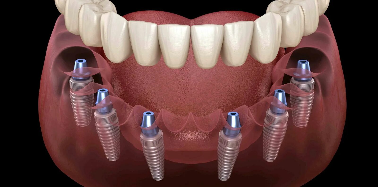 Протезирование зубов на имплантах фото Системы имплантов All-on-6. Преимущества и особенности. Доступная стоматология и