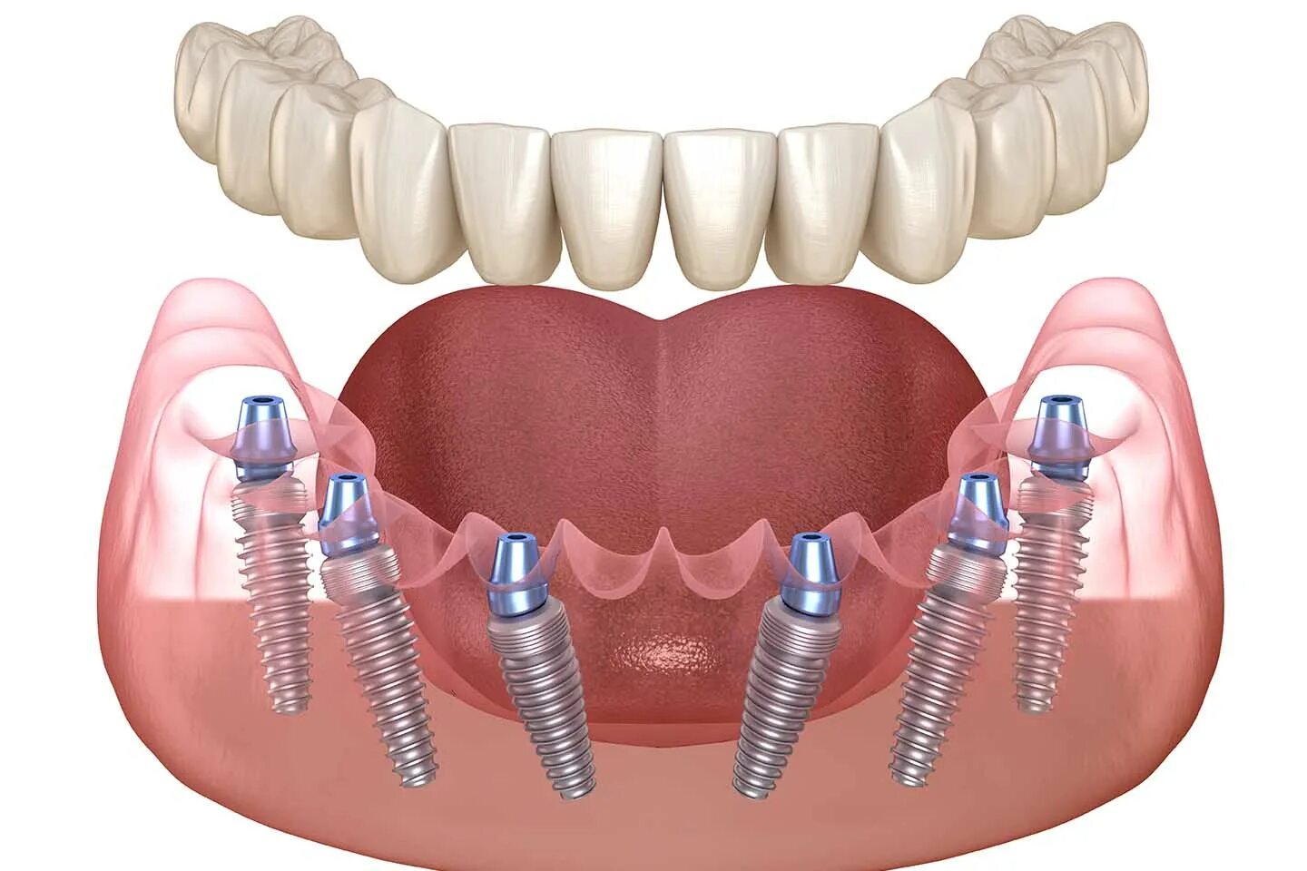 Протезирование зубов на имплантах фото Протезирование при полном отсутствии зубов недорого в Москве, виды и цены