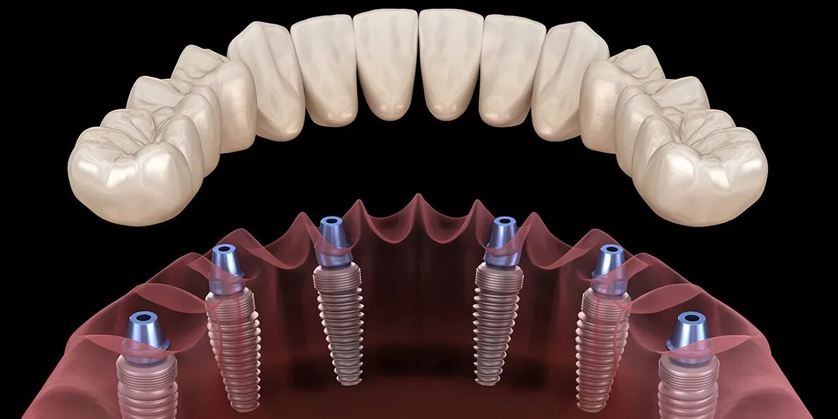 Протезирование зубов на имплантах фото Виды имплантов и технологии имплантации зубов На пике здоровья и красоты Дзен