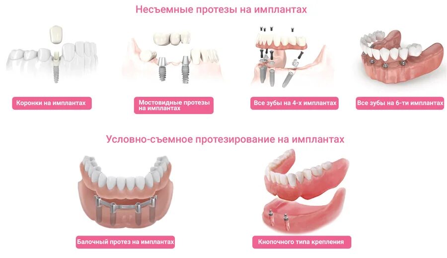 Протезирование зубов виды какой протез лучше фото Как проводится имплантация зубов и в чем разница между одиночными имплантами и с