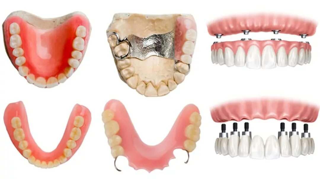 Протезирование зубов виды протезов фото Зубные протезы в Сочи - протезирование зубов недорого в стоматологии "Скаковский