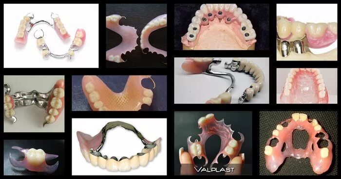 Протезирование зубов виды протезов фото Вставной зуб 5 букв - найдено 90 картинок