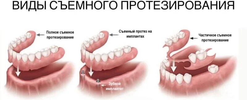 Протезирование зубов виды протезов фото цена Съемные зубные протезы в СПб Клиника "Премьера"