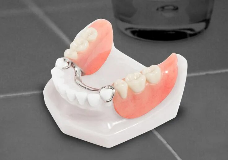 Протезы на жевательные зубы как выглядят Partial denture is essential #LakeWorth #Florida #Dentist, health, Dr. Suarez #C