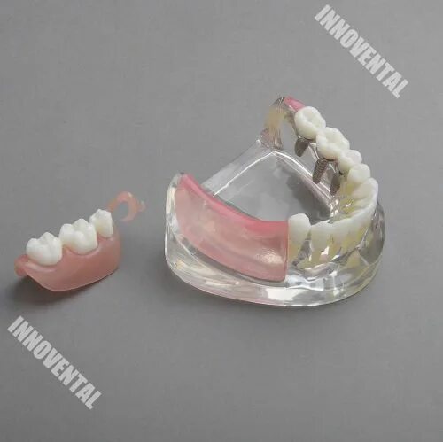 Протезы на жевательные зубы как выглядят Dental Model #6006 01 - Lower Jaw Implant & Unilateral Denture - TZSupplies.com