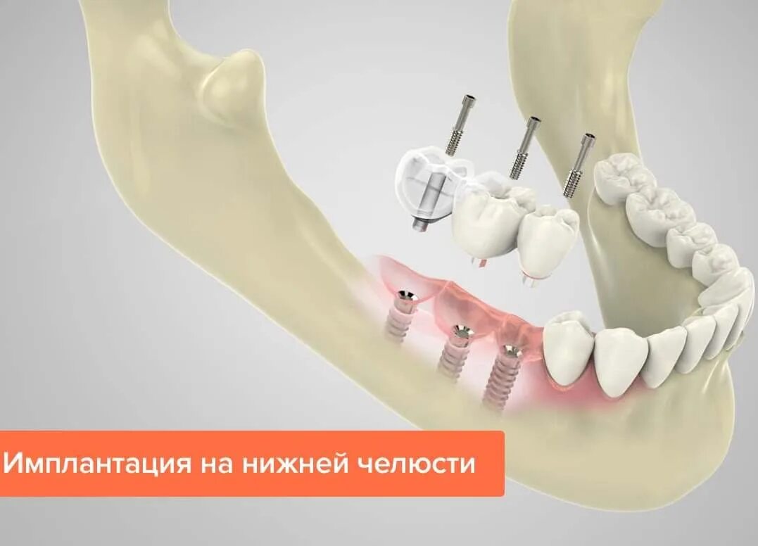 Протезы на жевательные зубы верхней челюсти фото Имплантация нижней челюсти Стоматология Василенко