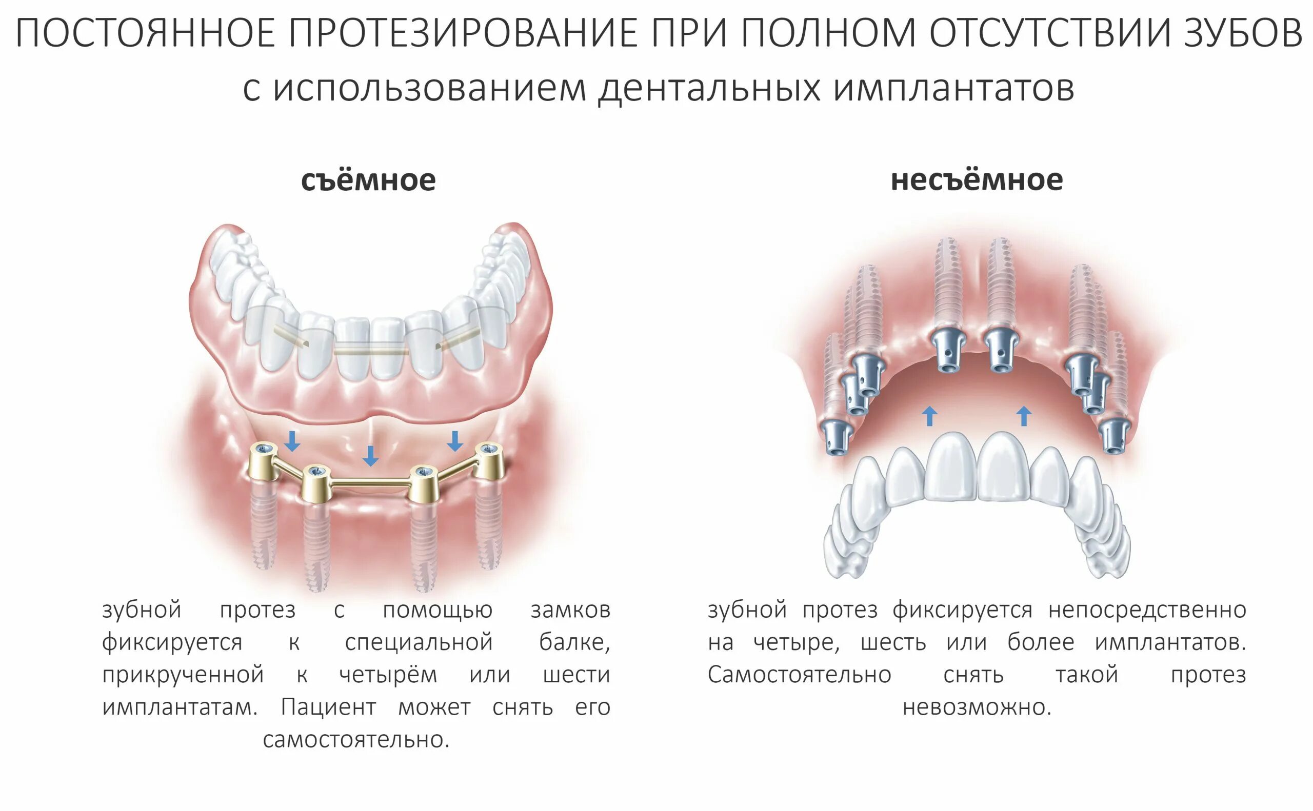 Протезы при полном отсутствии зубов фото Схема установки имплантов зубов на нижней челюсти