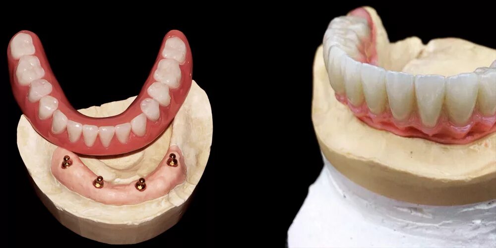 Протезы при полном отсутствии зубов фото Протезирование на имплантатах - Dr.Tokarev Moscow Dental Studio / Виниры, Отбели