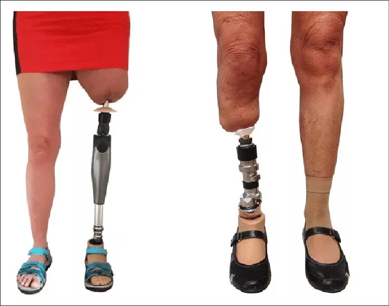 Протезы выше колена цена и фото Bone-anchored prostheses. Right: transfemoral bone-anchored prosthesis... Downlo