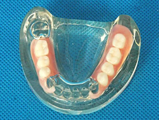 Протезы жевательных зубов фото A dental prosthesis can be secured to one or more implants. It can be made of on