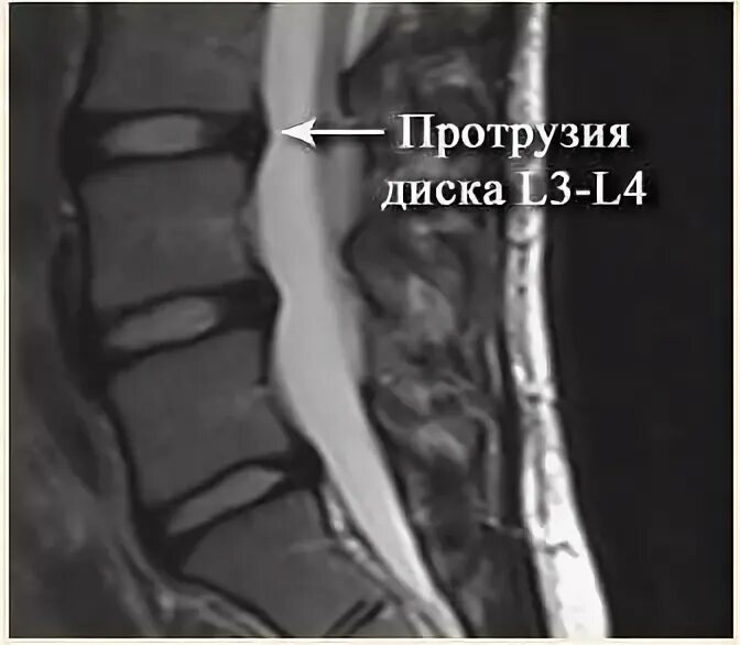 Протрузии межпозвонковых дисков фото Протрузия дисков 3 мм - найдено 86 картинок