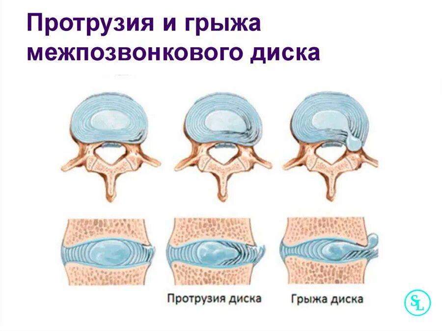 Протрузии межпозвонковых дисков фото Боль в области поясницы у женщин, причиняй, виды, лечение в Москве