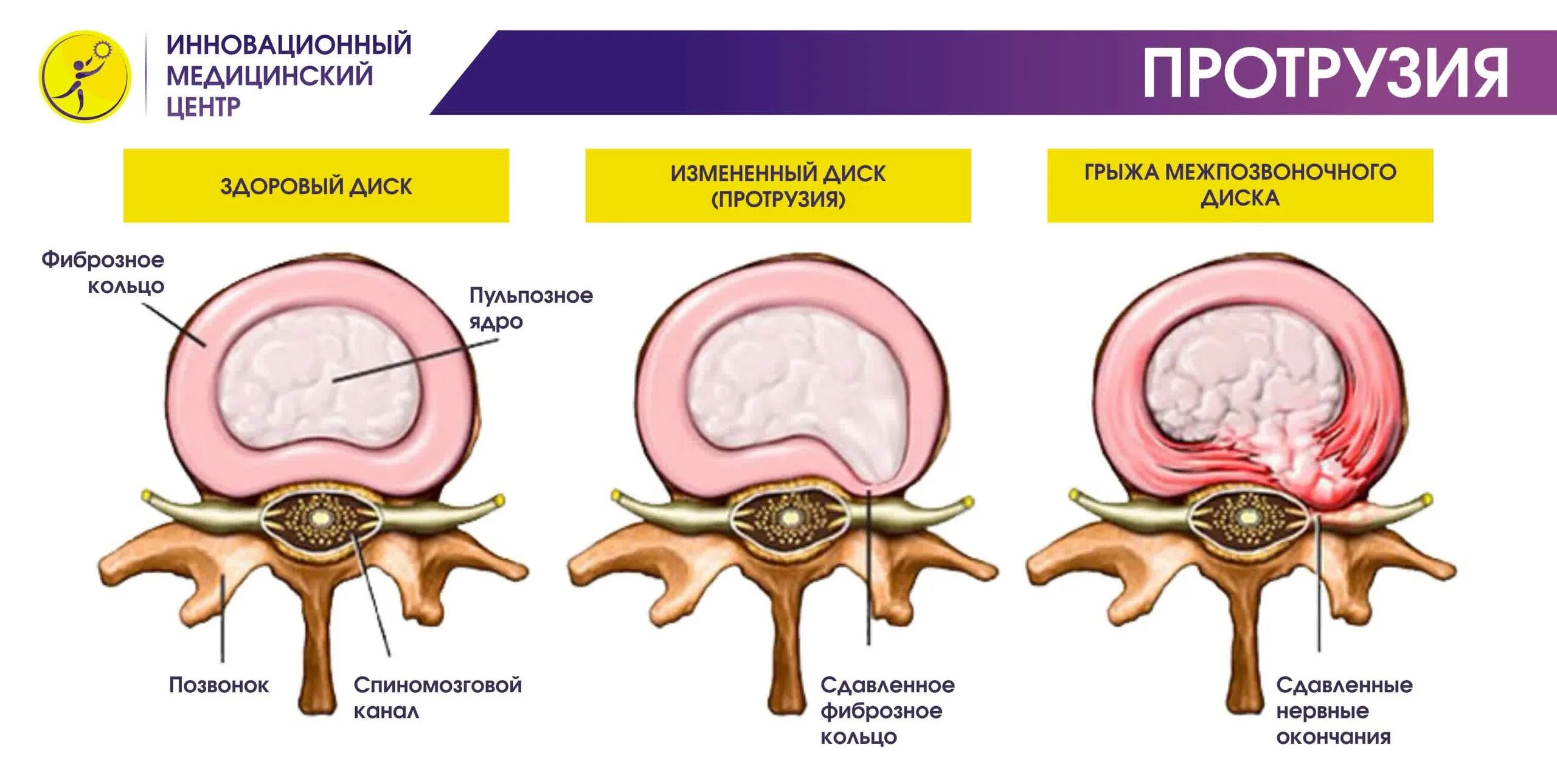 Протрузии межпозвонковых дисков фото Операция протрузия позвоночника
