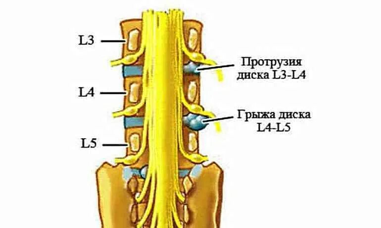 Протрузии межпозвонковых дисков фото Фото@Mail.Ru: : Фото группы