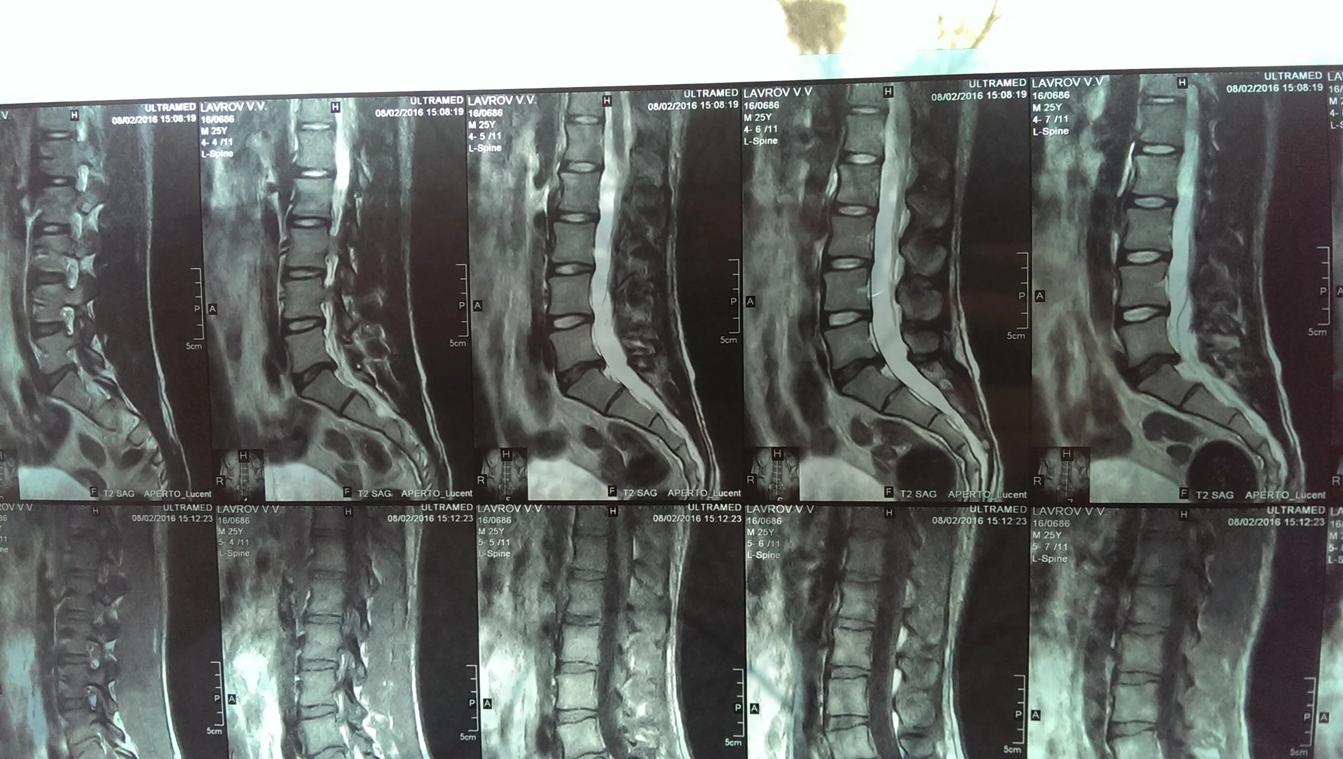 Протрузии поясничного отдела фото Мрт пояснично-крестцового отдела Рентгенограммы Сайт Тимура Гусейнова