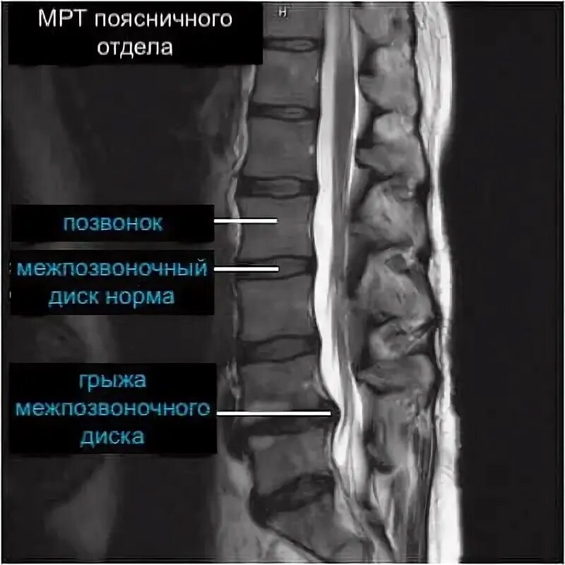 Причины боли в спине в области поясницы