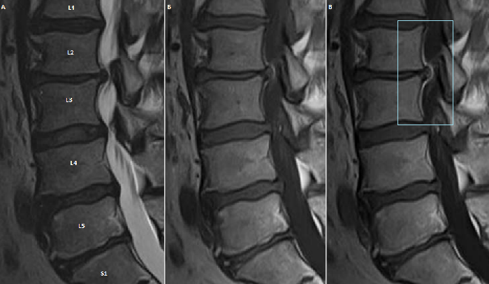 Протрузии поясничного отдела фото Как выглядит протрузия на МРТ - ExpertNeuro