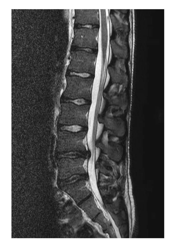 Протрузии поясничного отдела фото Lumbar disc herniation in three patients with cystic fibrosis: a case series Jou