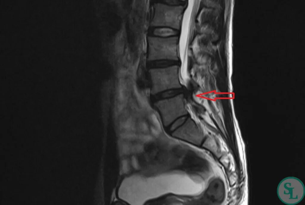 Протрузии поясничного отдела фото Грыжа межпозвонкового диска L4-L5 слева
