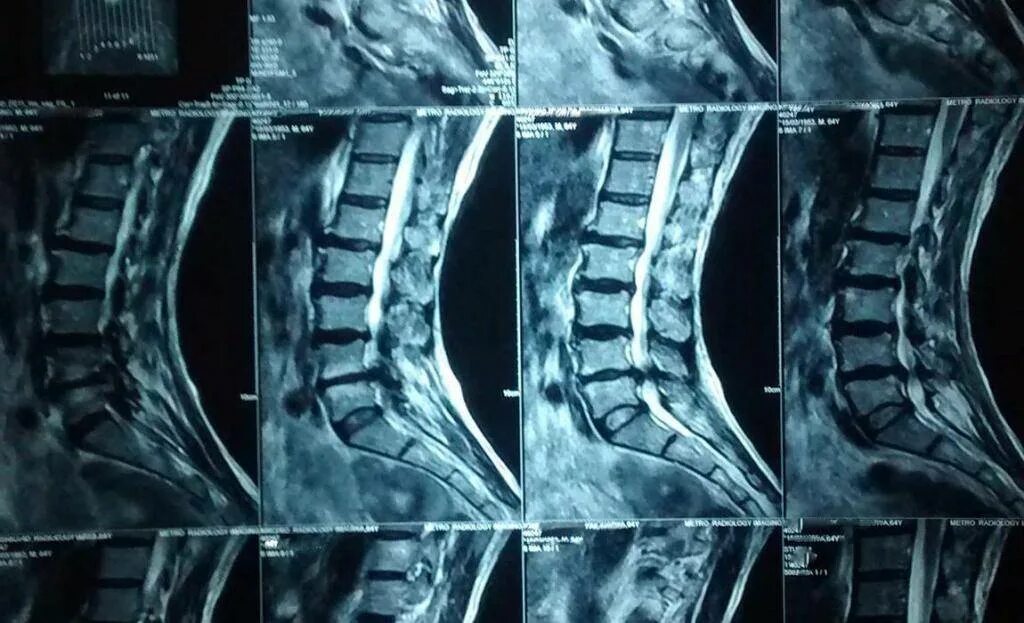 Протрузии поясничного отдела фото Протрузия рентген