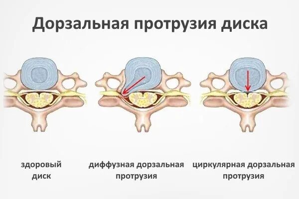 Протрузия дисков фото Парамедиальная экструзия