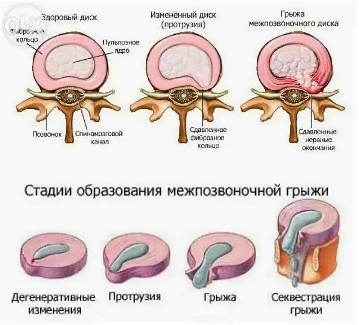 Протрузия дисков фото Дорзальная экструзия протрузия