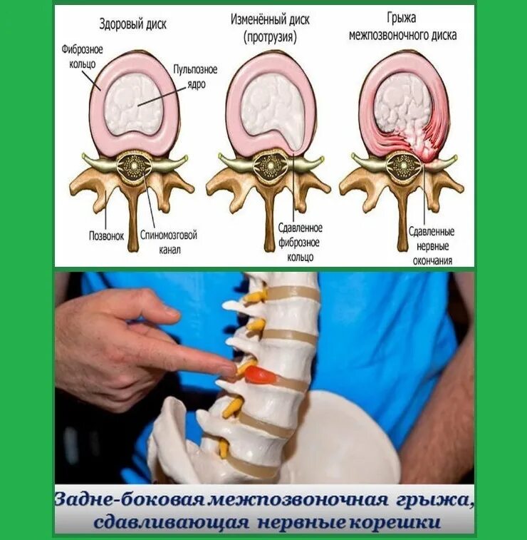 Протрузия дисков фото Возьмут ли на службу в армию с протрузией позвоночных дисков