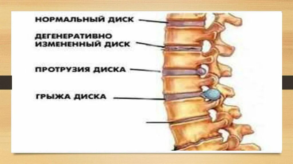 Протрузия дисков фото Протрузия 4 позвонка