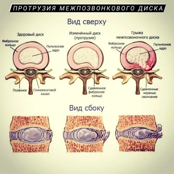 Протрузия дисков фото Дорзальная экструзия протрузия