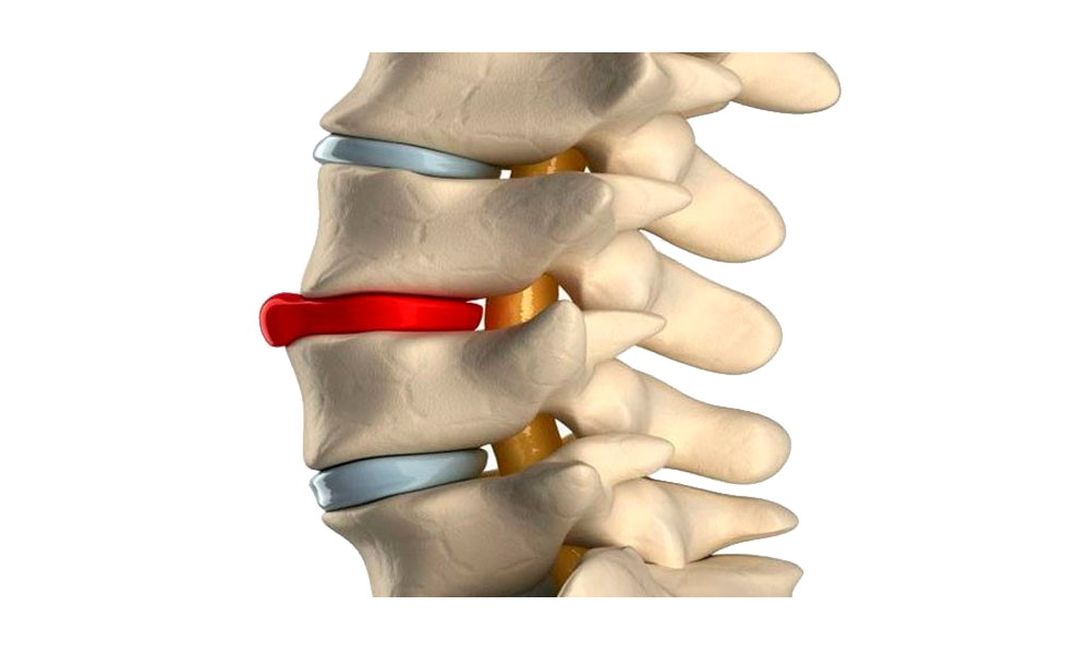 Протрузия дисков позвоночника фото Возможно ли лечение грыжи без операции